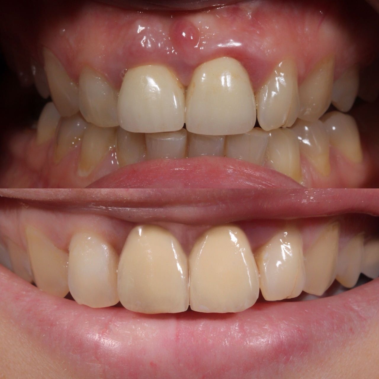 Smile design и керамические коронки — до и после